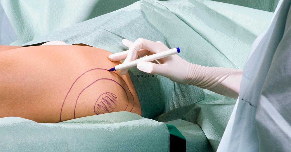 تجربتي مع الدكتور رياض البقمي في شفط الدهون