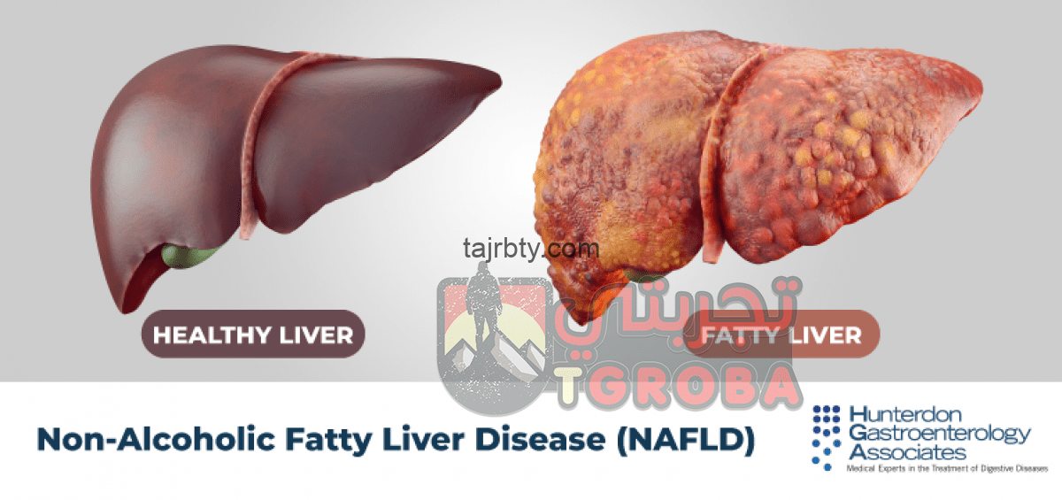 تجربتي لعلاج دهون الكبد