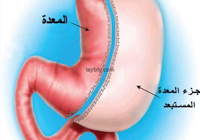تجربتي مع كرمشة المعدة
