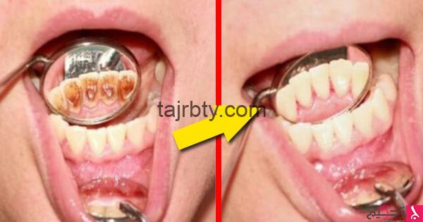 إزالة جير الأسنان تجربتي