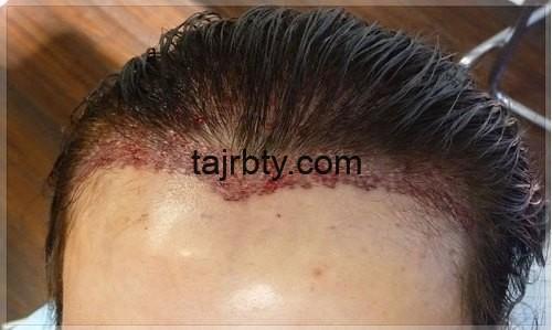 تجربتي في زراعة الشعر بتقنية dhi