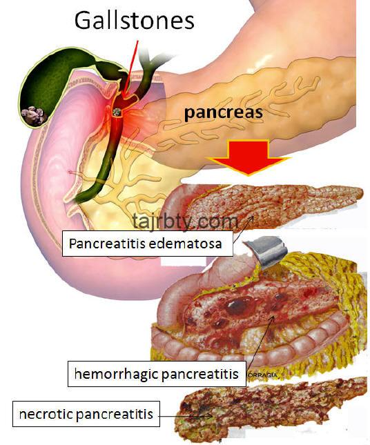 علاج التهاب البنكرياس البسيط