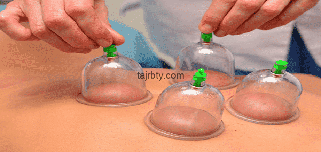 تجربتي مع الحجامة لتكيس المبايض