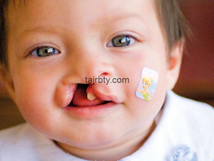 تجربتي مع تجميل الشفة الارنبية