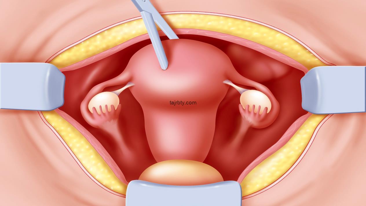 تجربتي مع نزيف الرحم
