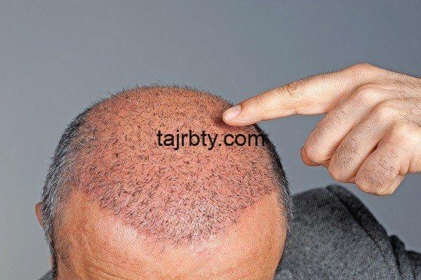 زراعة الشعر في تونس