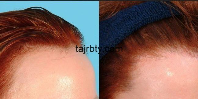 مراحل عمل زراعة الشعر وأهم الاحتياطات اللازمة