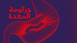كم يستمر علاج جرثومة المعدة؟ كم يستمر علاج جرثومة المعدة؟